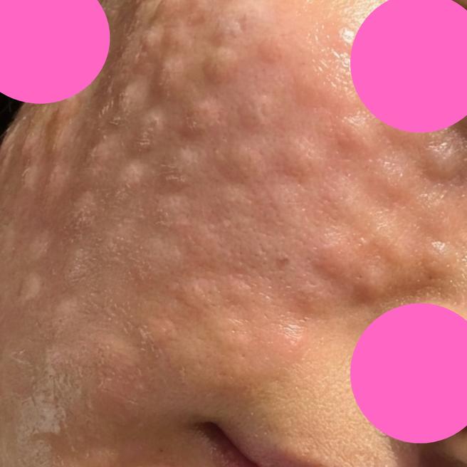 리쥬란 1일차 후기~! 생각보다 할 만해요