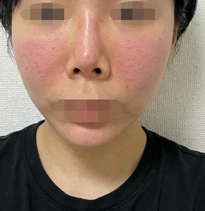 여드름 때문에 포텐자 받았는데 시술 끝나고 바로 좋아진 것 같아요ㅎㅎ