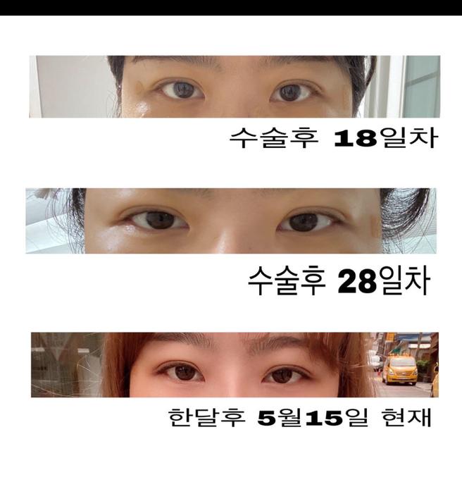 ศัลยกรรมตาแก้ไขอย่างมั่นใจ