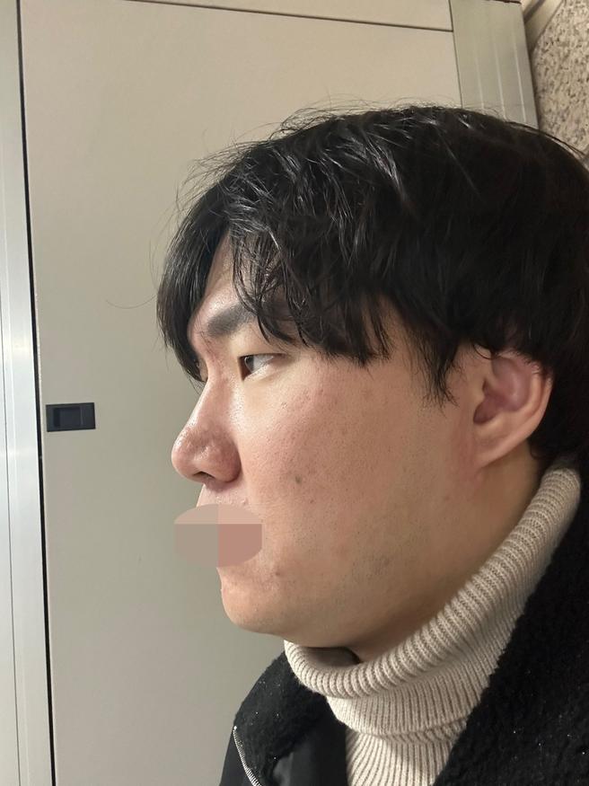 남자 눈매교정