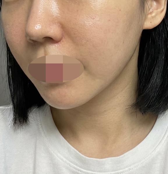 양 볼 홍조랑 트러블 고민, 리쥬란으로 7일 차에 변화 느꼈어요~
