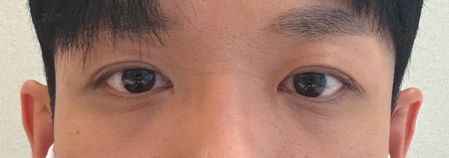 男性目元矯正