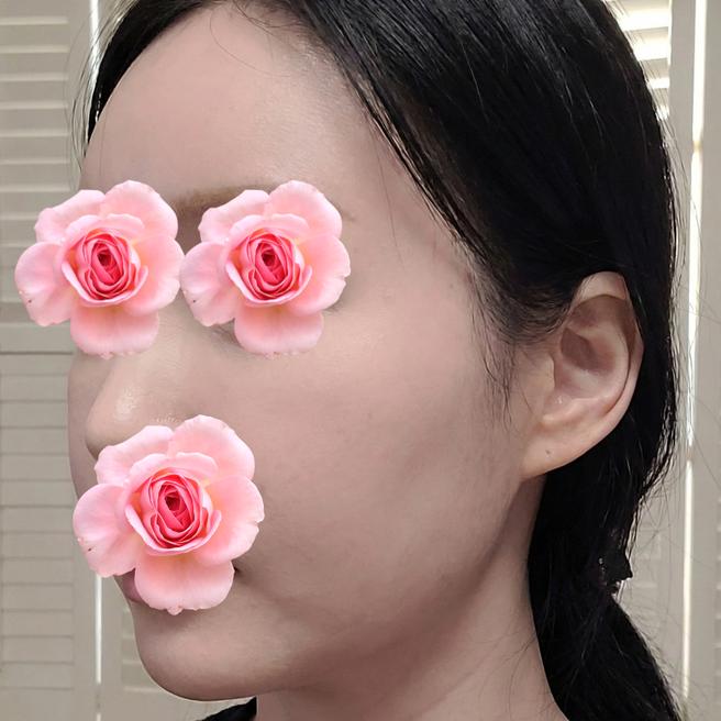 실리프팅 받은 지 이틀, 붓기 빠지고 나면 어떻게 될지 너무 기대돼요 