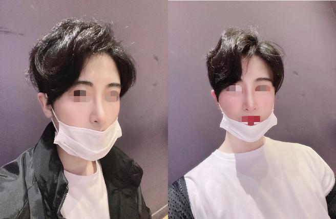 男性目元矯正