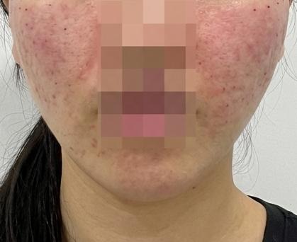 모공이랑 속건조, 수면으로 편하게 리쥬란 받고 왔어요~!