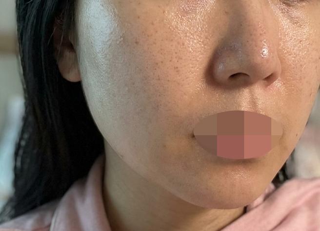평소엔 리즈네만 받았는데 이번엔 스킨보톡스까지 같이 받아봤어요!!
