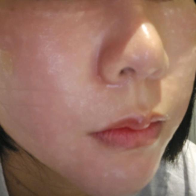 원장님 손기술 믿고 받는 포텐자 당일 후기!