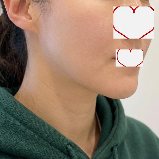 붓기 없이 이렇게 된다고요?! 온다리프팅 1일차 리얼
