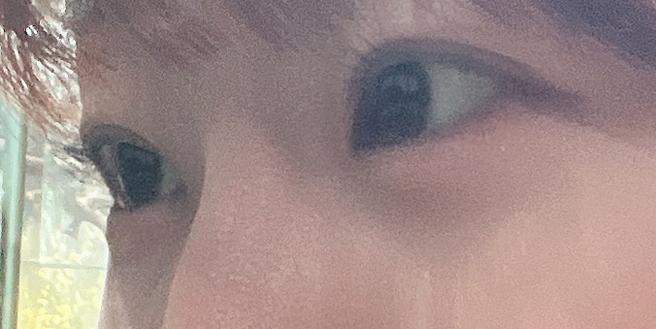 แก้ไขรูปตาและกล้ามเนื้อตาอ่อนแรง