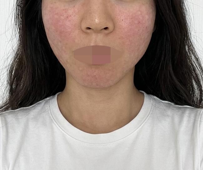 첫 수면 리쥬란 걱정 많았는데, 친절하게 챙겨주셔서 안심했어요ㅎㅎ