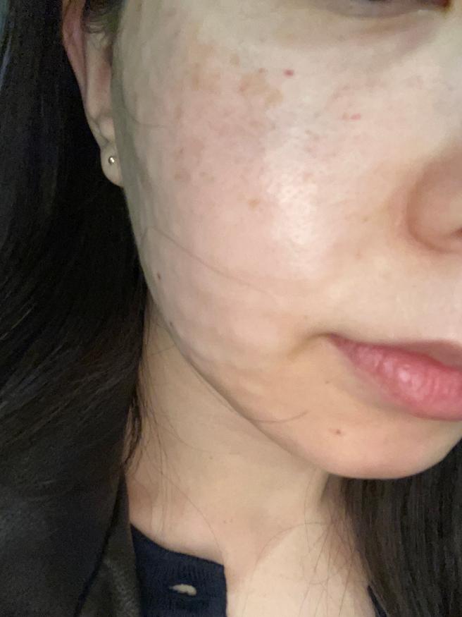 예비신부 피부 관리로 서울아이 리쥬란 선택한 2주차 후기예요