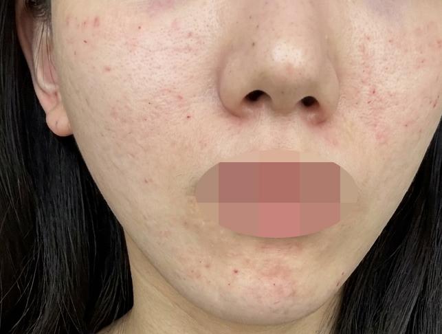 화장 들뜸 끊어내려고 받은 리쥬란, 결과 기대돼요!