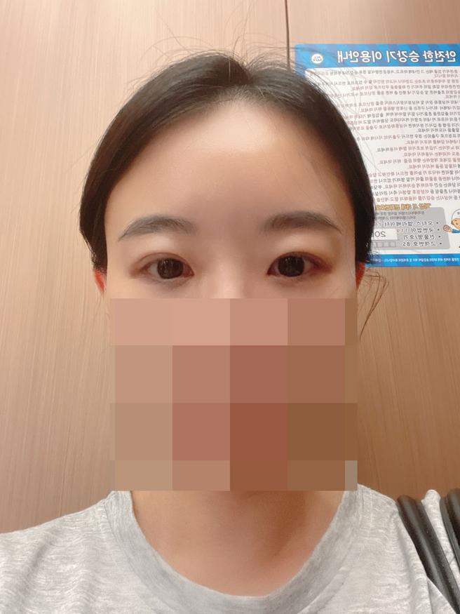 眼下脂肪の再配置