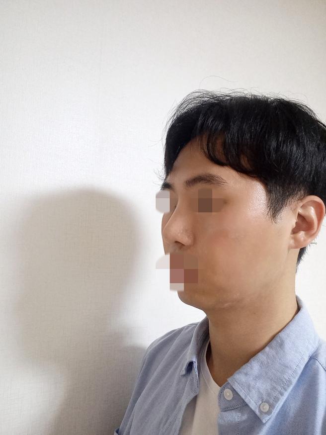 自家軟骨鼻再手術