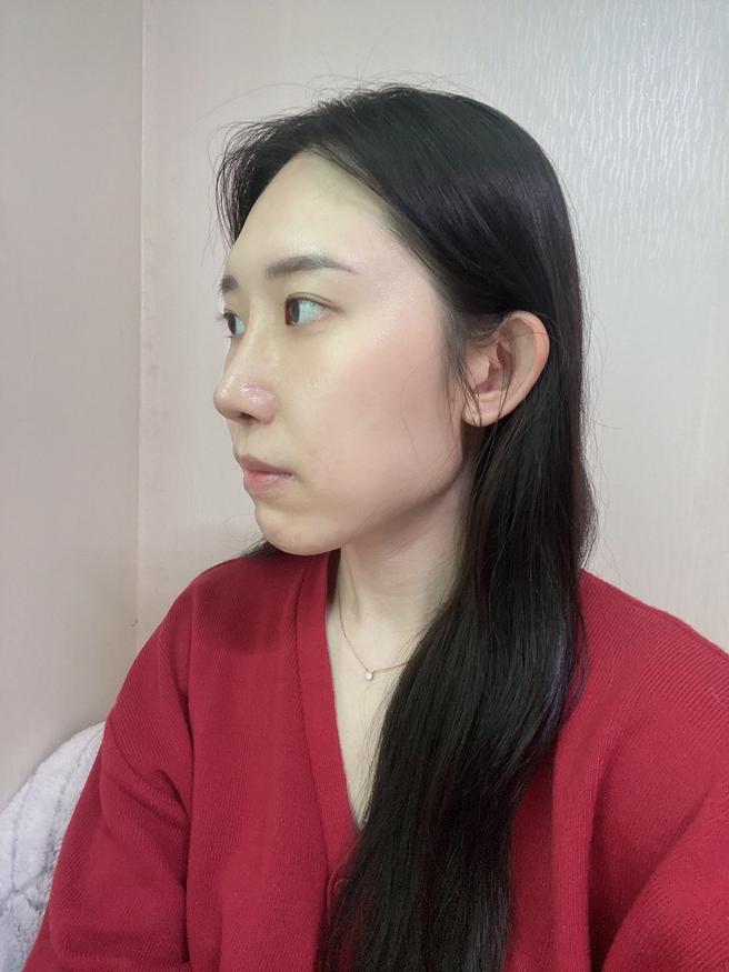 Revision Nose Surgery