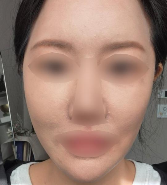 2주 만에 회복 끝! 다운타임 짧은 포텐자 재방문 후기