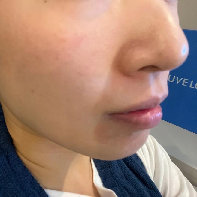 잔주름 쫙 펴짐! 촘촘한 리쥬란 + 역대급 친절함 (매달 오고픈 곳)