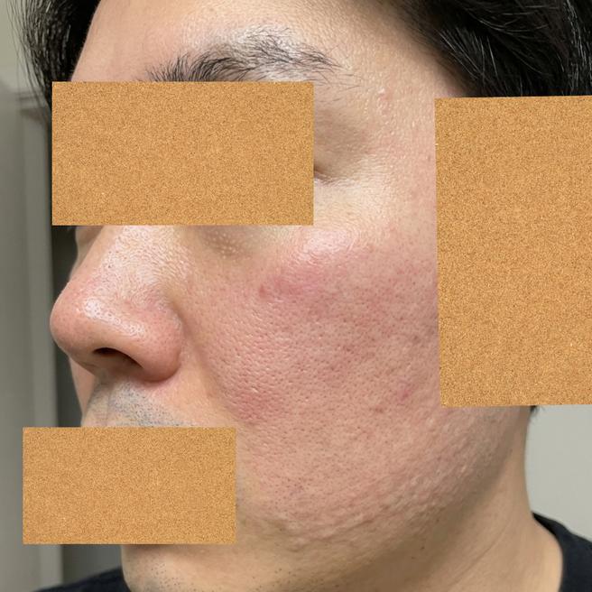 거울 보기 싫었던 남자, 리쥬란 5일차 변화 공유