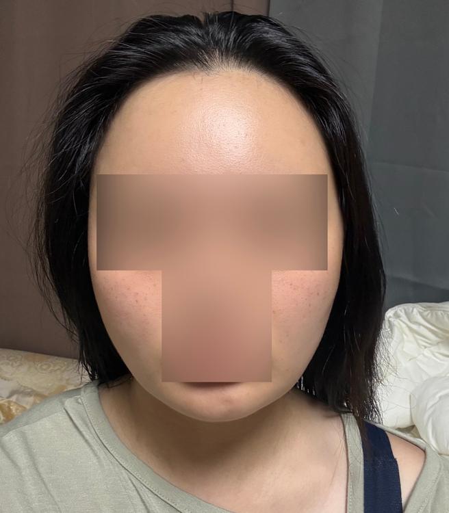 ดูดไขมันใบหน้า