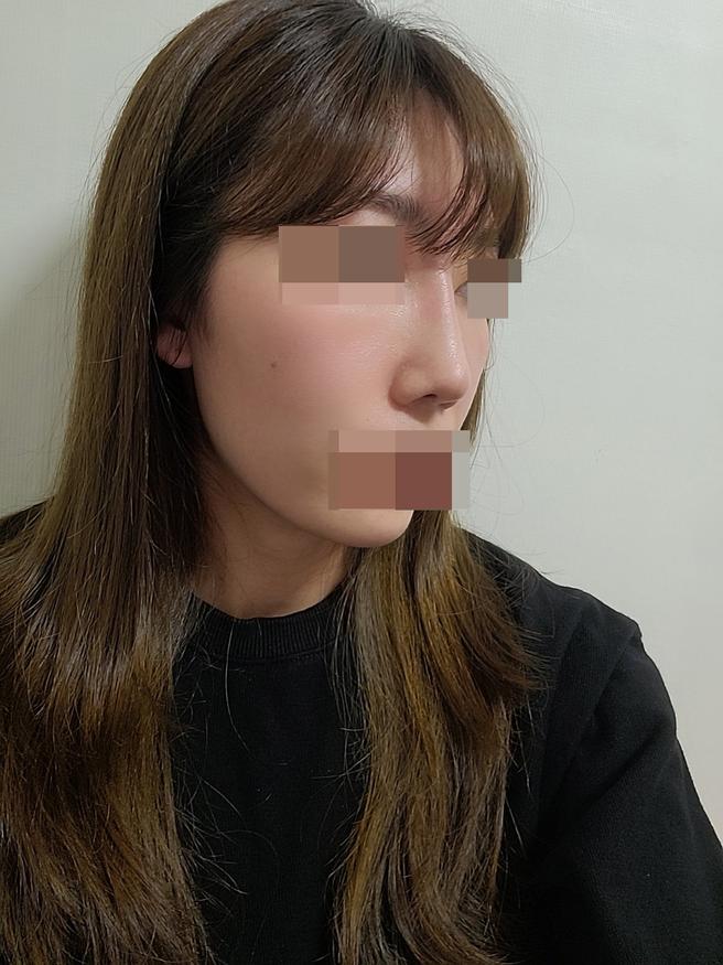 Autologous Costochondral Nose Revision