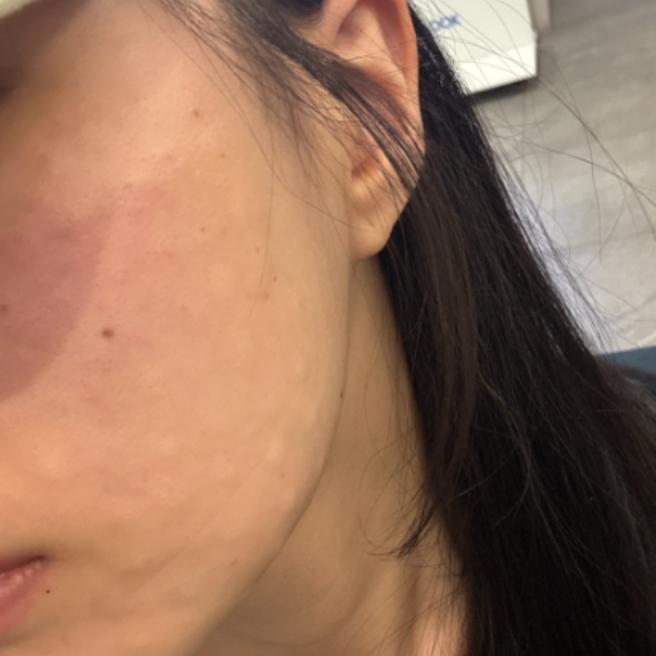리쥬란 1일차, 엠보는 남아있지만 피부 컨디션은 편안해요