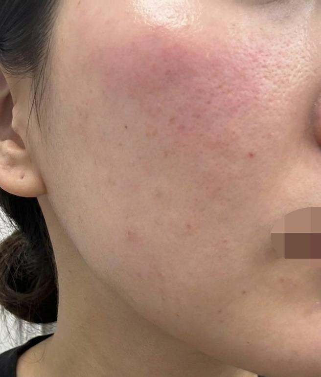 화장으로 가릴 필요 없는 피부, 시술로 답을 찾았어요~