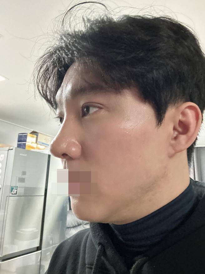 남자 눈매교정