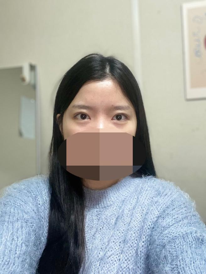 눈매교정&안검하수