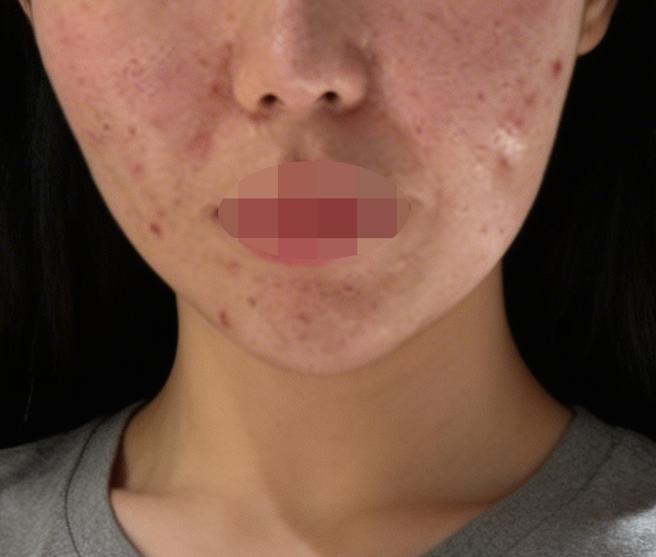 모공이랑 피부결 고민으로 역 근처 리쥬란 찾다가 방문했어요~!