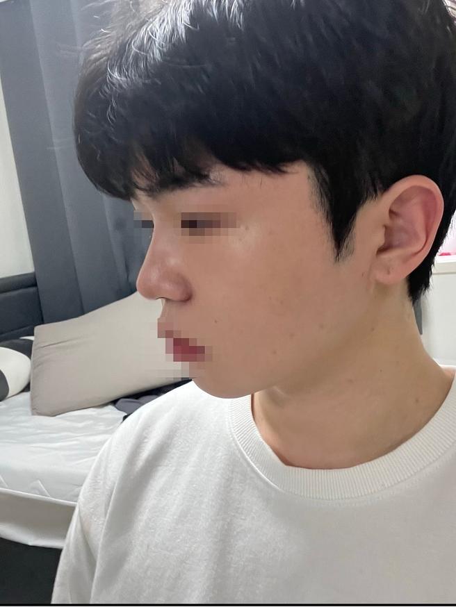 안심 코 재수술