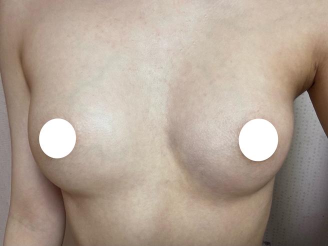 Stem Cell Chest Fat Grafting