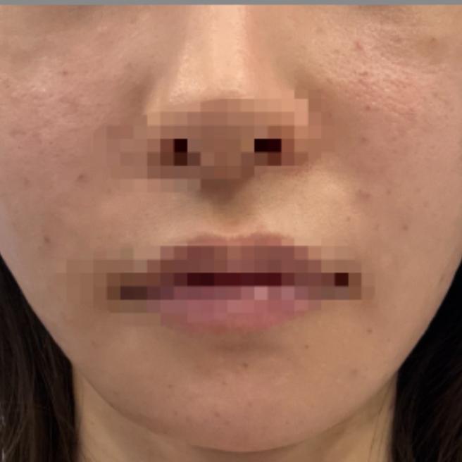 모공과 피부결 고민으로 받은 리쥬란 5일차