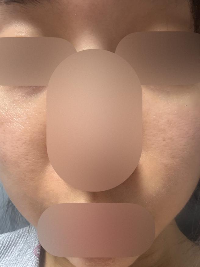 리쥬란 맞고 일주일 다 돼가는데 슬슬 기대되기 시작하네용!