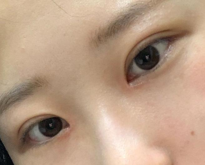 眼幅矯正＆眼瞼下垂