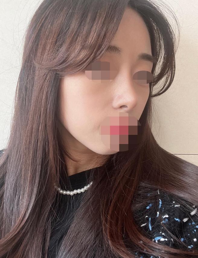 ศัลยกรรมจมูกแก้ไขอย่างมั่นใจ