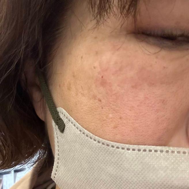 피부 속부터 케어하고 싶어 리쥬란 받은 1일차 후기