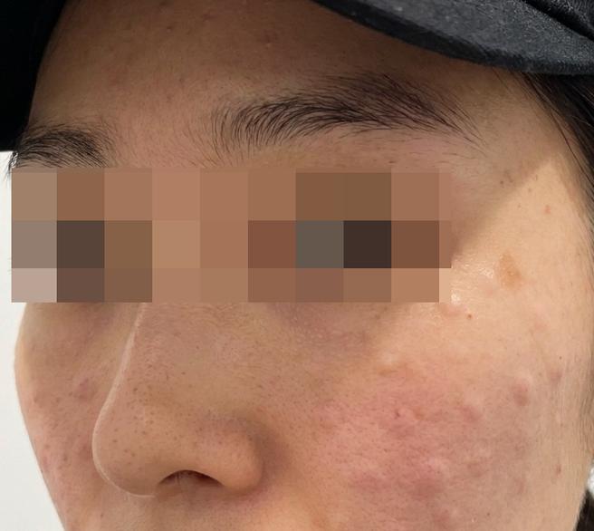 잔주름엔 스킨보톡스가 답! 만족스럽게 받고 왔어요~ㅎㅎ