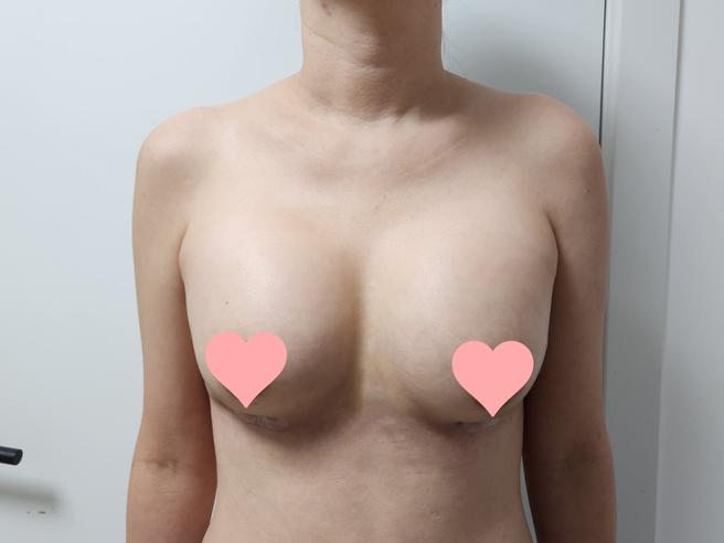 내추럴가슴보형물