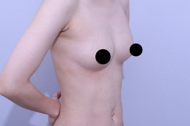 Stem Cell Chest Fat Grafting