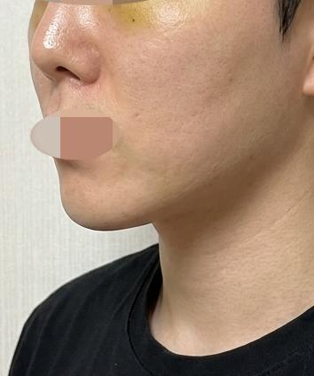 이해하기 쉽게 설명해주신 실리프팅, 결과도 너무 만족이에요~