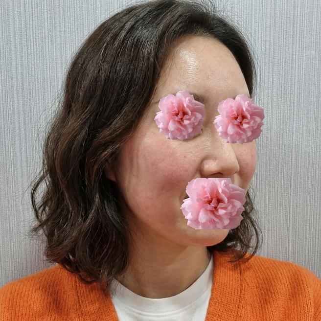 리쥬베룩 맞고 3일 됐는데 슬슬 가라앉는 것 같아요