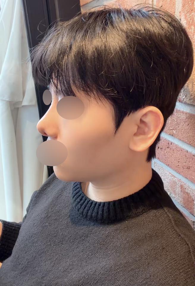 ศัลยกรรมจมูกครั้งแรก