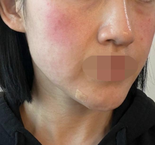 수면으로 통증 없이 받은 리쥬란, 빠른 응대까지 좋았어요ㅎㅎ
