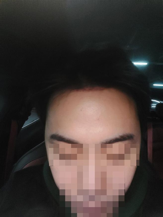 額頭縮小