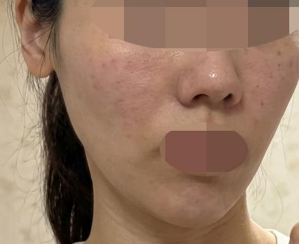 건조함이랑 눈가 잔주름 고민으로 받았는데 받길 잘한 것 같아요!