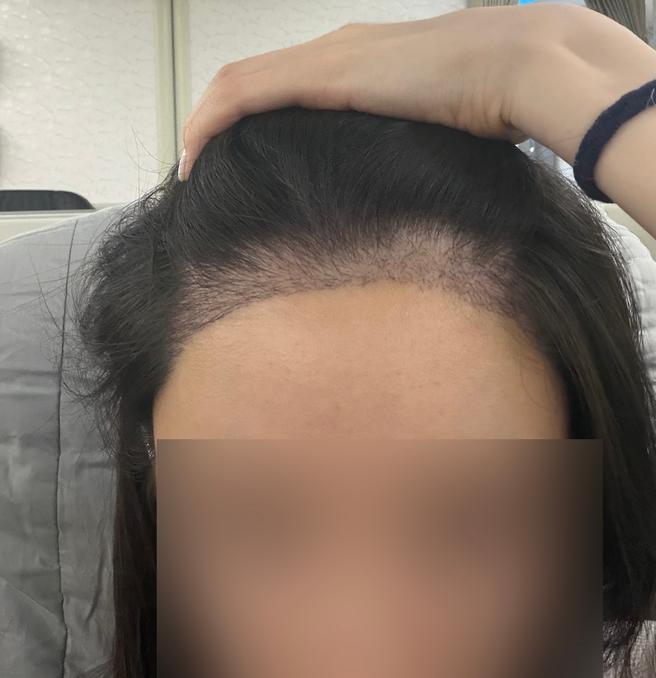무삭발모발이식