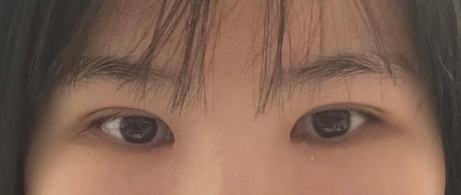 부분절개쌍꺼풀