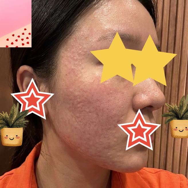 일본에서도 한국 와서 받는 수면 리쥬란! 정중한 스탭에 또 감동