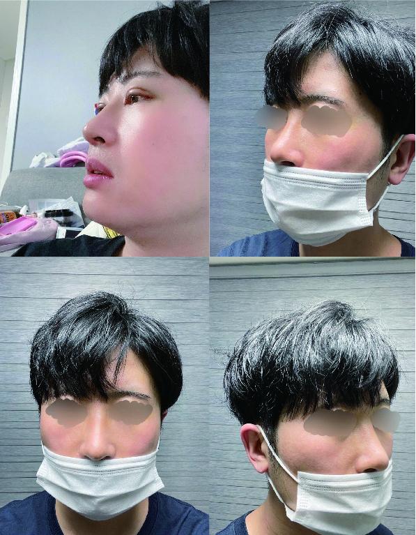 남자 눈매교정