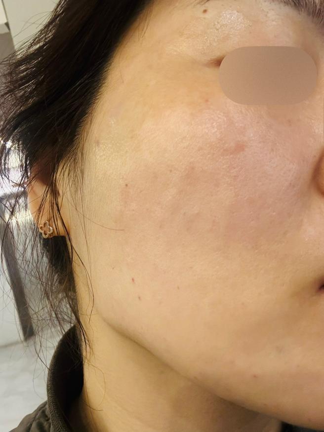 멍도 없고 후처리까지 완벽한 리쥬란, 앞으로 여기서 쭉 할게요~